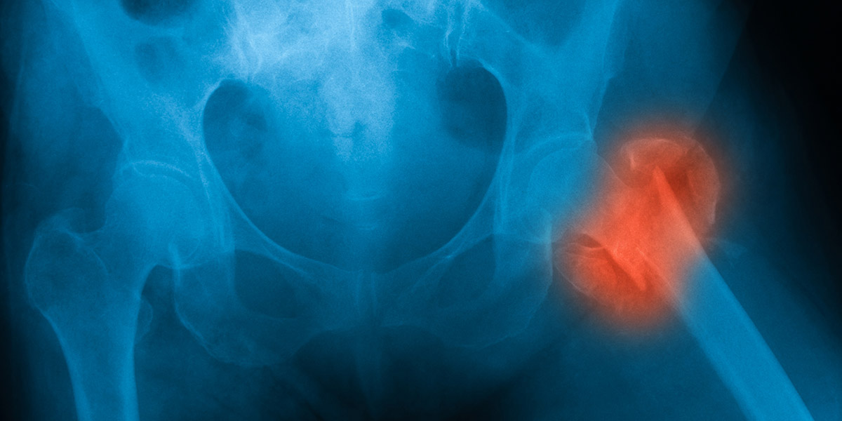 X-ray image of both hip, AP view.