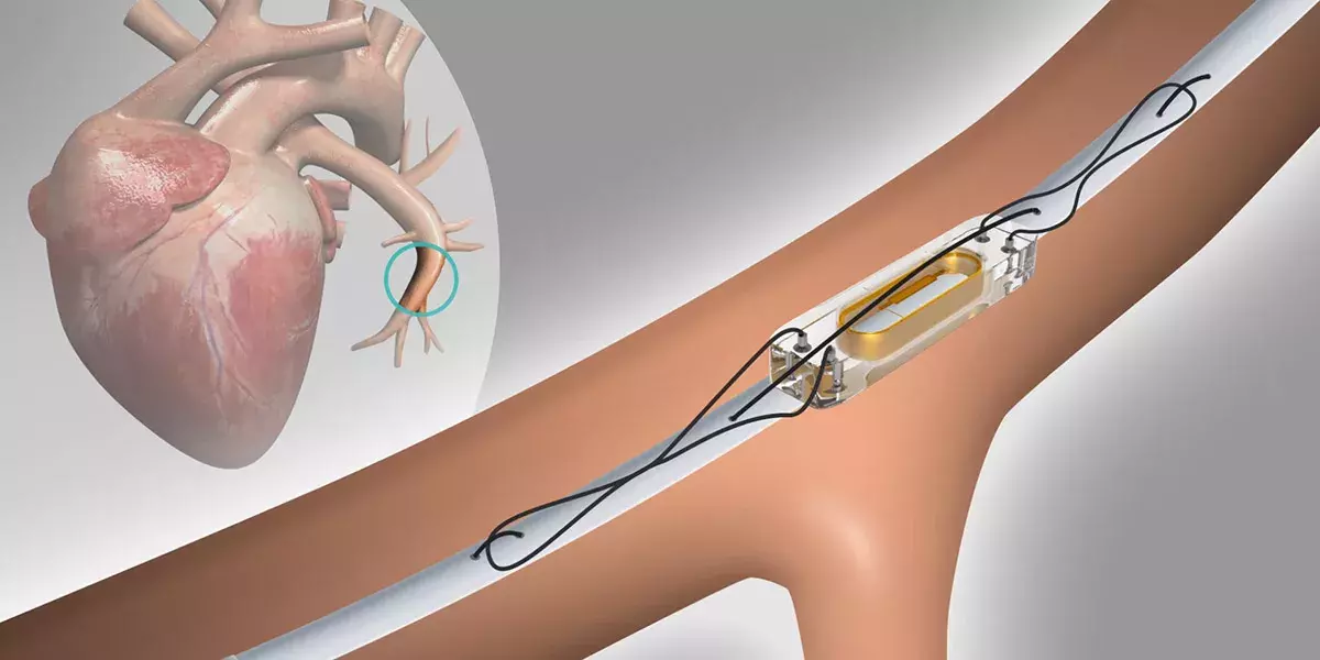 CardioMEMS keeps heart patients out of the hospital
