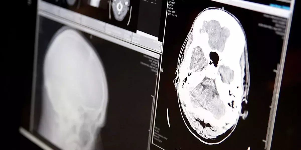 A black and white x-ray of a brain with a concussion